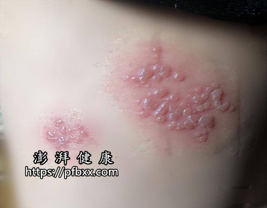 疱疹传染不 来自搜狐网