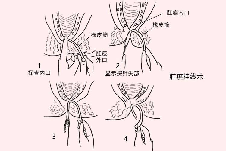 肛瘘手术到底有多痛?