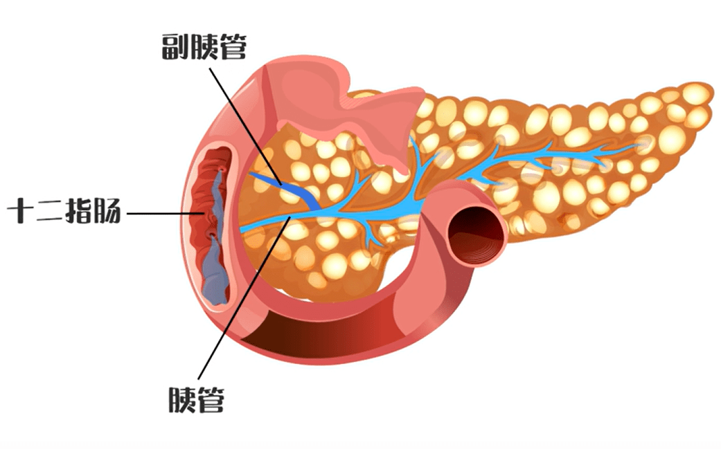 胆源性胰腺炎