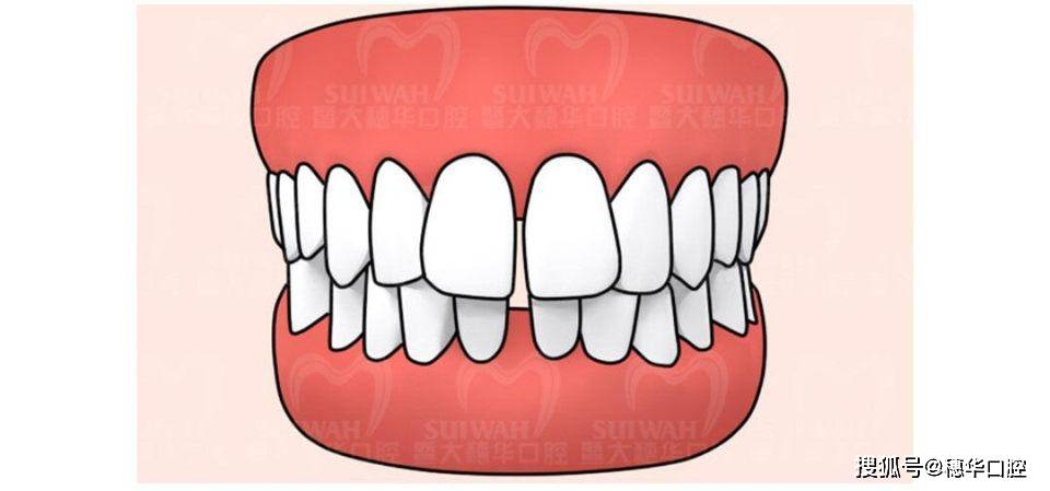 舌头放错位置竟影响牙齿和颜值?快看看你的舌头放对了吗?