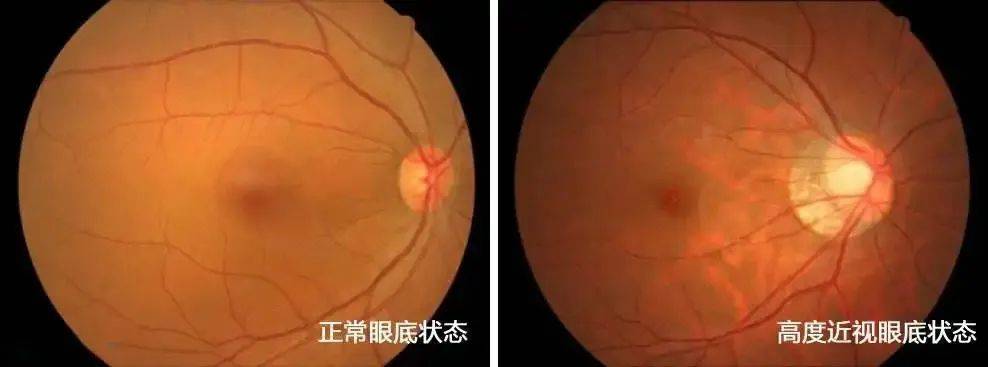 兰州爱尔眼科医院丨陈雪艺院长 一张眼底照片藏着多少秘密(图2)
