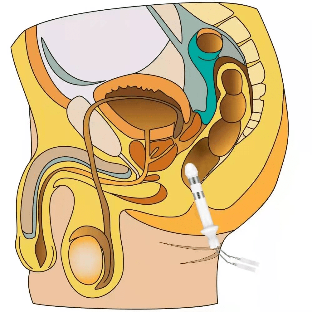 男性盆底肌"生物刺激反馈仪"评估不容忽视_功能_尿道_疾病