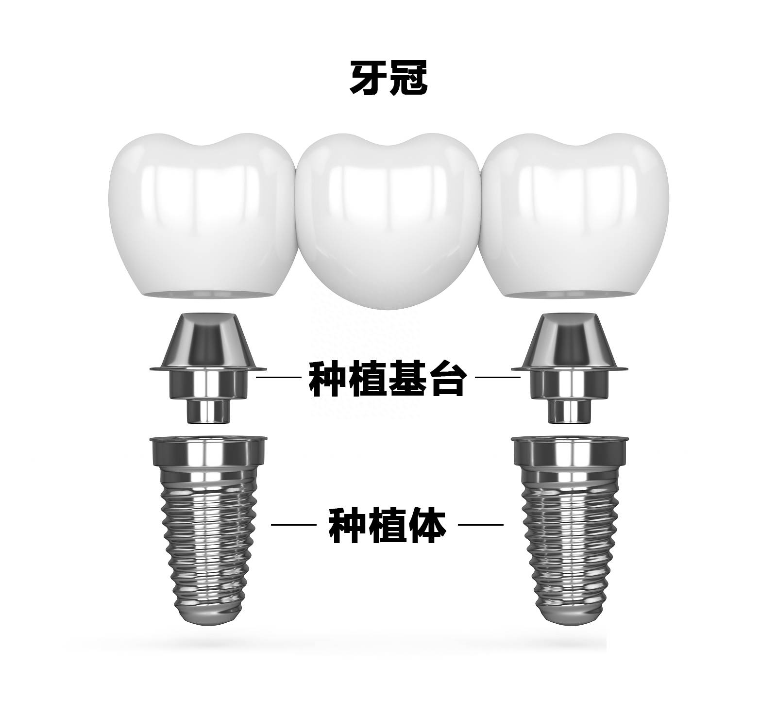 牙医朋友看过,个性化基台介绍以及选择