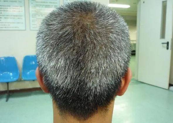 长在前额,两鬓,后脑勺,分别说明了啥_青丝_头发_维生素
