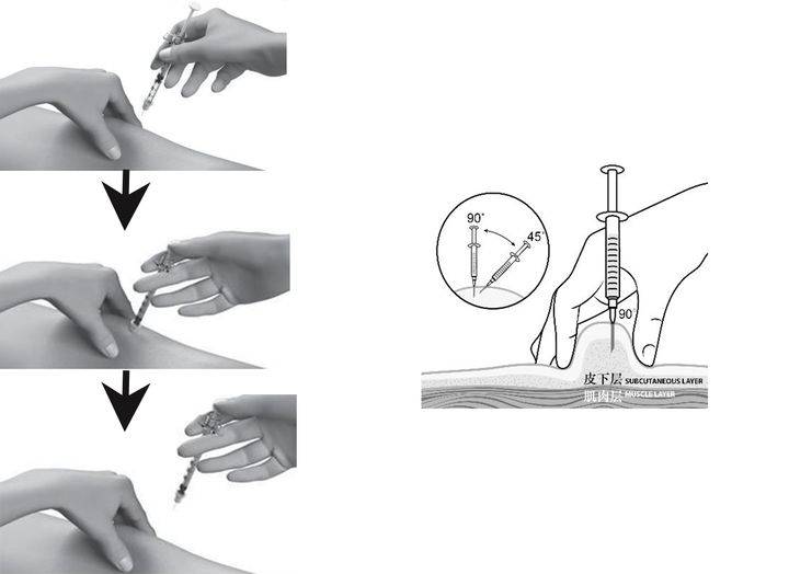 注射器部位图解图片