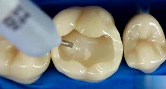 楔缺或邻面洞充填位置近龈缘时,为避免龈沟液的影响,须在相应位置排龈