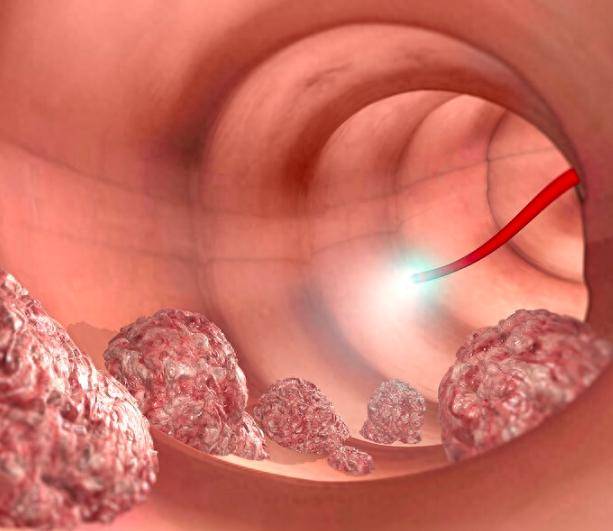 肠镜能发现早期肠癌,医生:有这4种情况的人,建议尽早检查_症状_粪便
