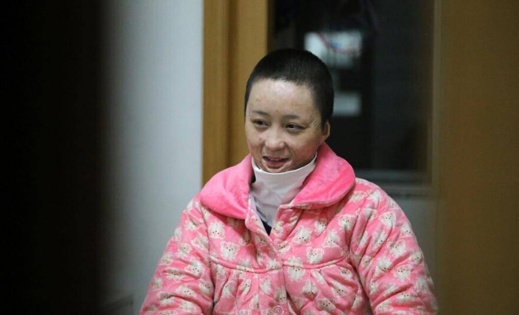 10年前合肥女孩拒绝同学求爱,竟遭对方一把火毁容,如今怎么样了_周岩