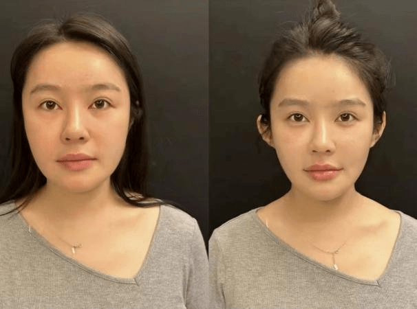 外轮廓是指,从发际线沿着面部外侧,一直到下巴,整个的u型 v型轮廓,也