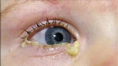 或灼烧感泪液分泌量增加(水汪汪的大眼睛)常见于病毒和过敏性结膜炎