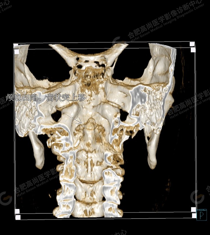 病例科普:术前检查头颅ct平扫发现"颅底凹陷症"_测量_枕骨_形态