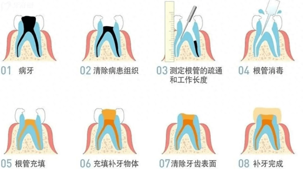 根管治疗全过程示意图
