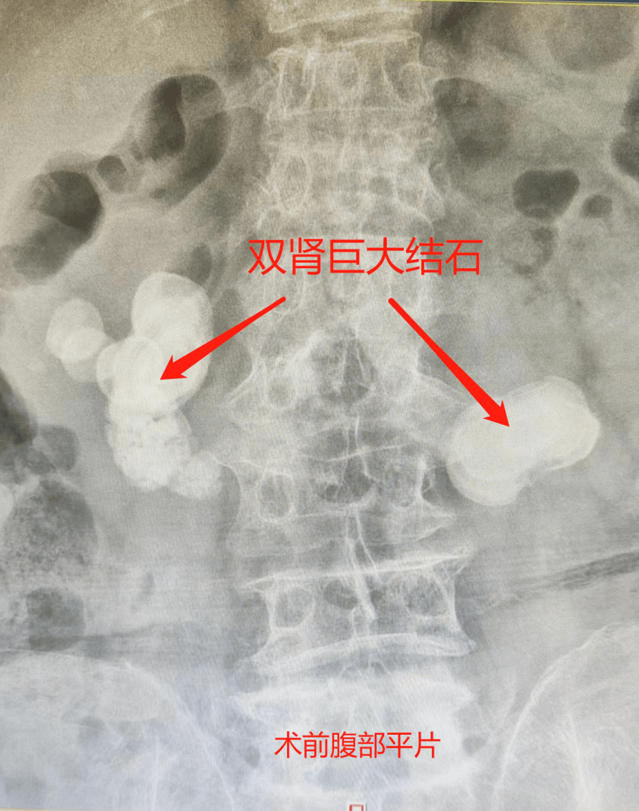 正医广东顺德临床中心近期收治多例疑难病,专家各显神通逐一破解_膀胱