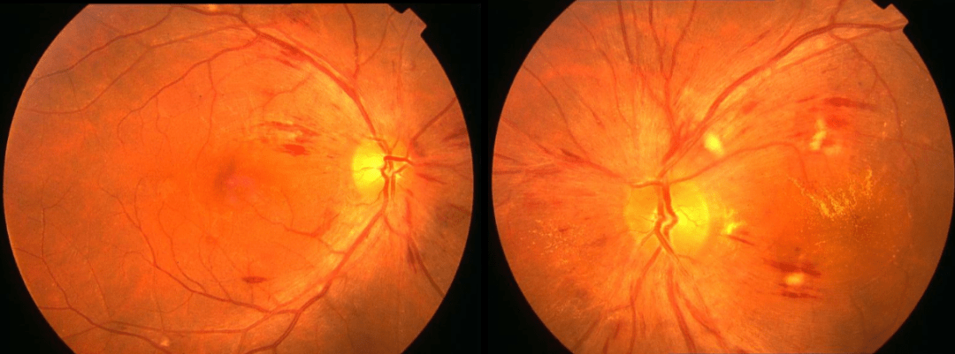 视神经乳头水肿是视神经乳头无原发性炎症的被动性充血水肿.