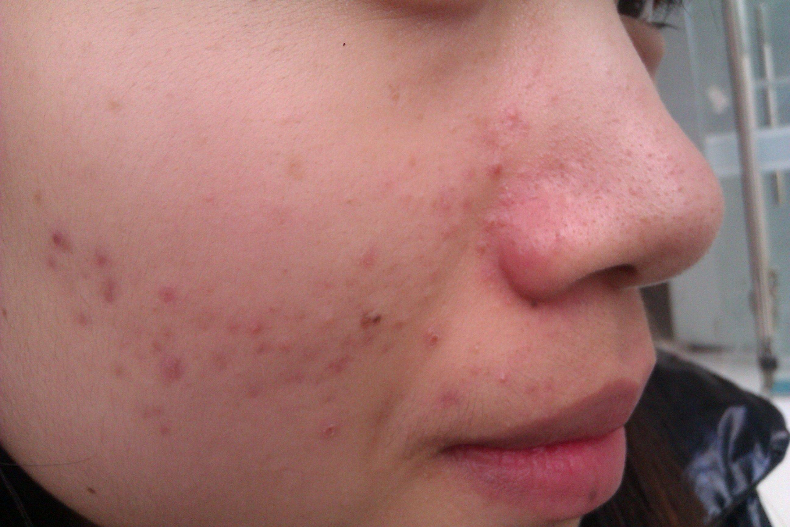 子沐老师:轻松"战痘",恢复光洁美肌_产品_皮肤_粉刺