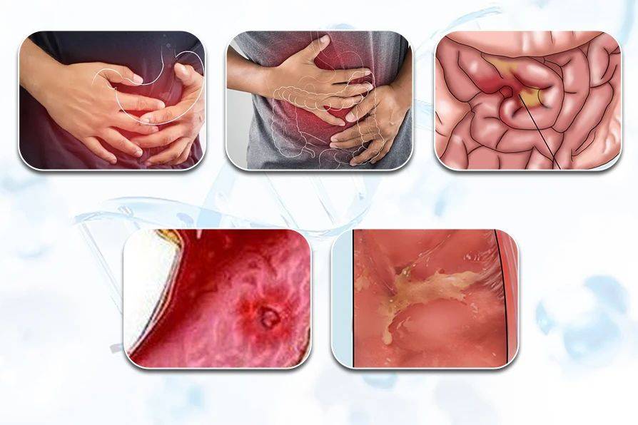 正常的肠鸣音是每分钟4-5次,声音较小,很少会被人听见.