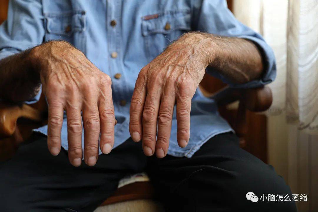 【小脑萎缩的相关科普】小脑萎缩患者大概可以活多久?_寿命_影响_治疗
