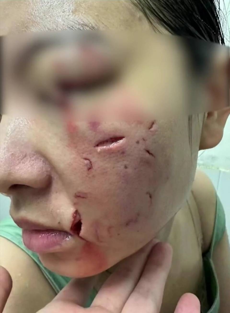 10岁男孩儿遭大型犬咬伤严重,连续三天仍在icu抢救中_丹口镇_孩子