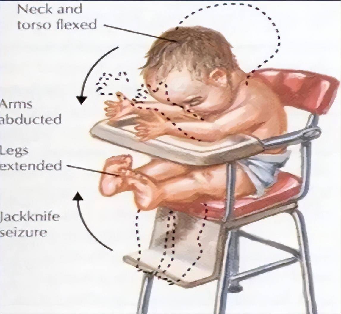 婴儿痉挛症脑电图图片