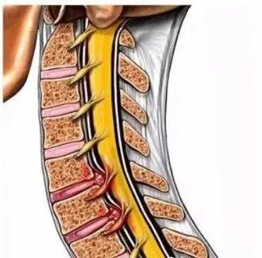 颈椎压迫脊髓早期症状图片