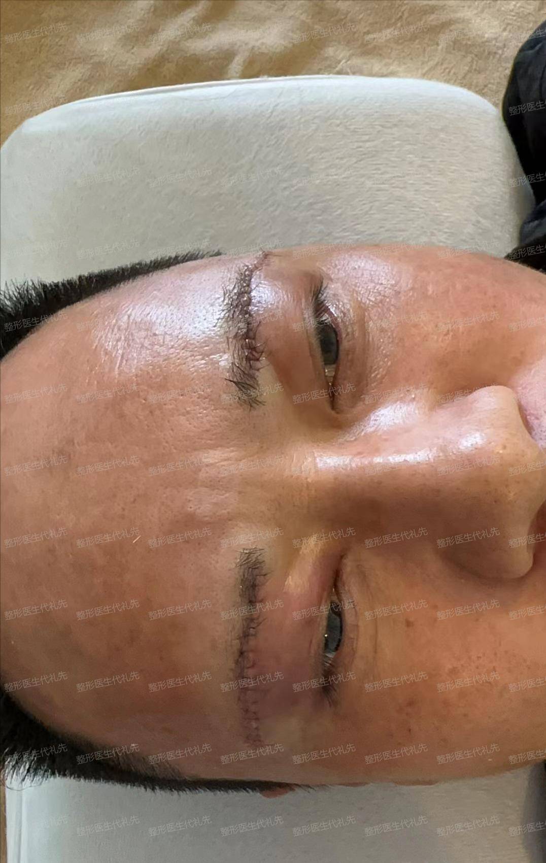 43岁先生,来北京做筋膜悬吊提眉手术,术后眼睛一下子就睁大变亮_切口
