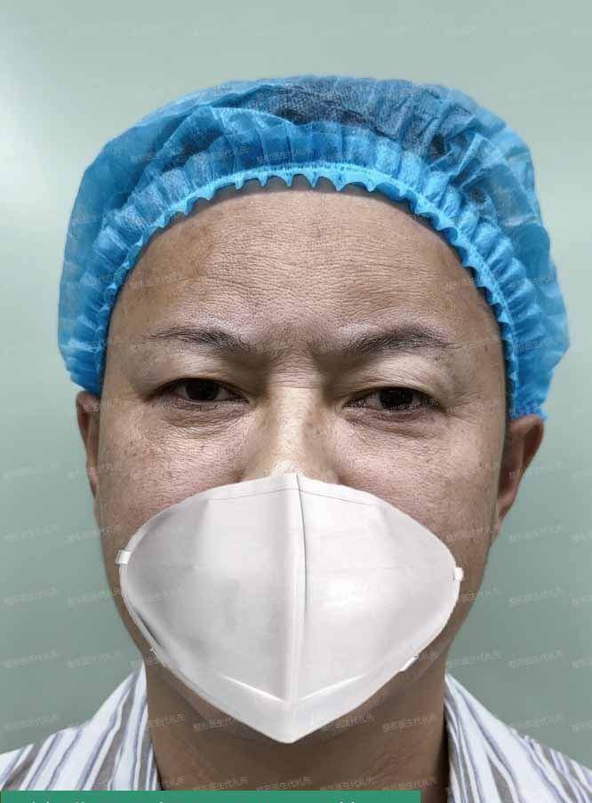 43岁先生,来北京做筋膜悬吊提眉手术,术后眼睛一下子就睁大变亮_切口