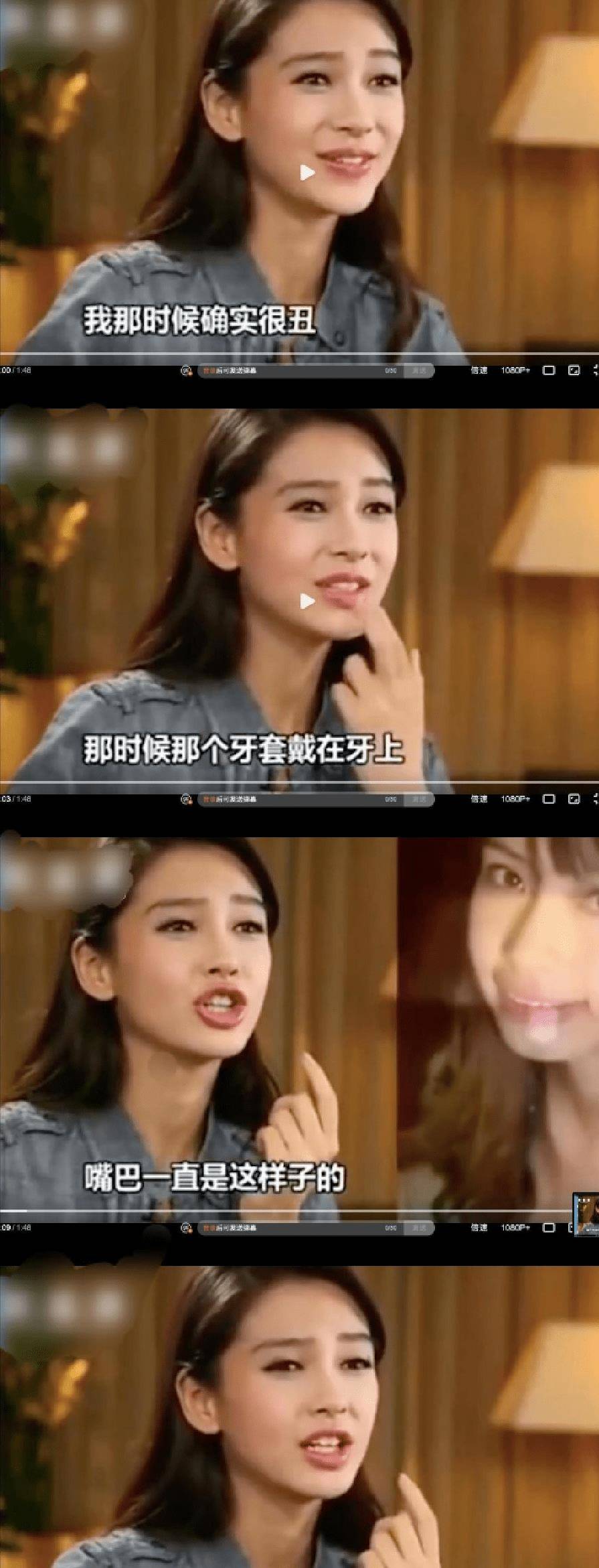 当时她的鼻子和眼睛已经很漂亮了,所以她选择了戴牙套,矫正牙齿