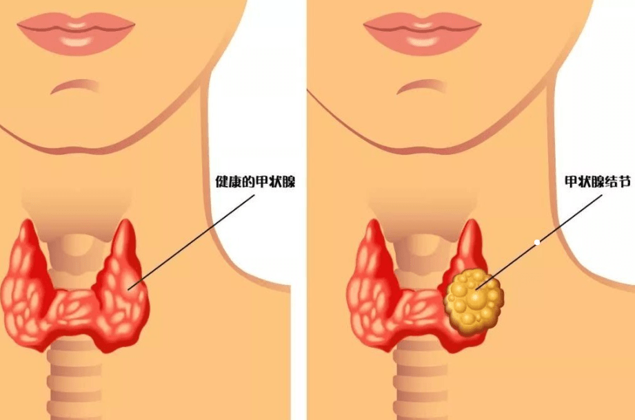 咽喉结节的症状图片图片