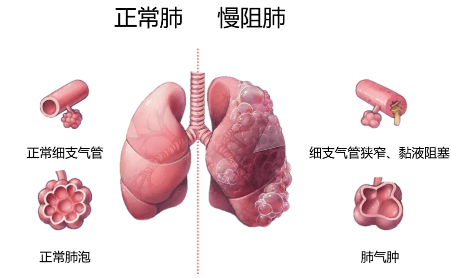 怎么判断胸痛还是肺痛图片