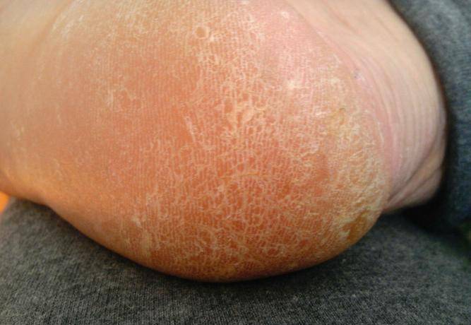 一举摆脱脚部脱皮,干燥,干裂,瘙痒等问题,轻松恢复敏感光滑肌肤!