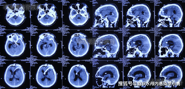 腦外傷後腦脊液鼻漏,動脈瘤術後和腦脊液鼻漏修補術後加重腦積水_頭顱