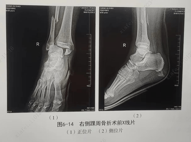 踝关节骨折ct图片图片