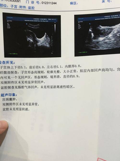 什么是宫颈囊肿,怎么办?