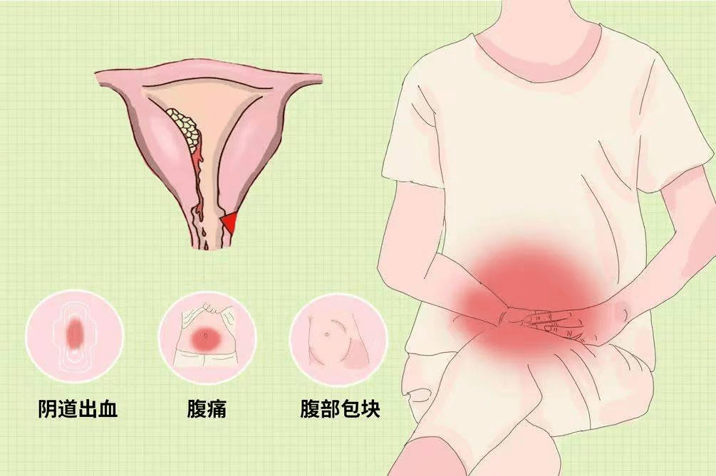 宫颈癌排出分泌物图片图片