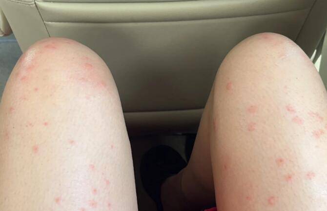 姨妈期遇上荨麻疹,血的教训!