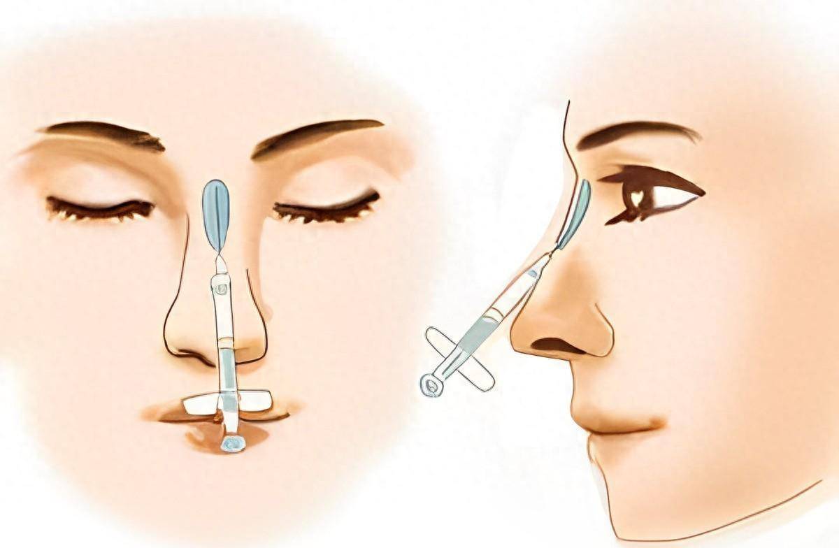 玻尿酸隆鼻:不再是鼻梁提升那么简单!