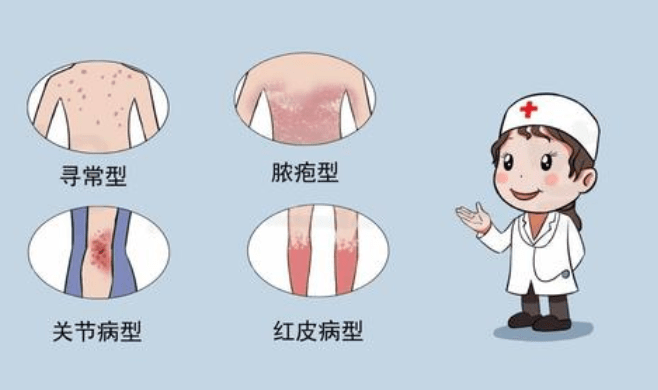 长沙鸿业皮肤专家科普:银屑病分为几个阶段?如何防治_治疗_医生_患者