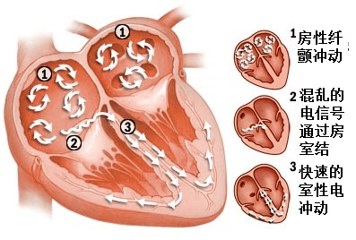 【为心护航】菏泽市牡丹人民医院获批"中国房颤中心建设单位"_患者_运
