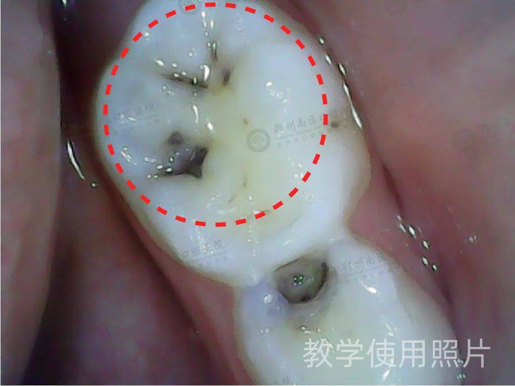 蛀牙狡猾難發現,竟然還有這麼多副面孔?_牙齒_口腔_世界衛生組織