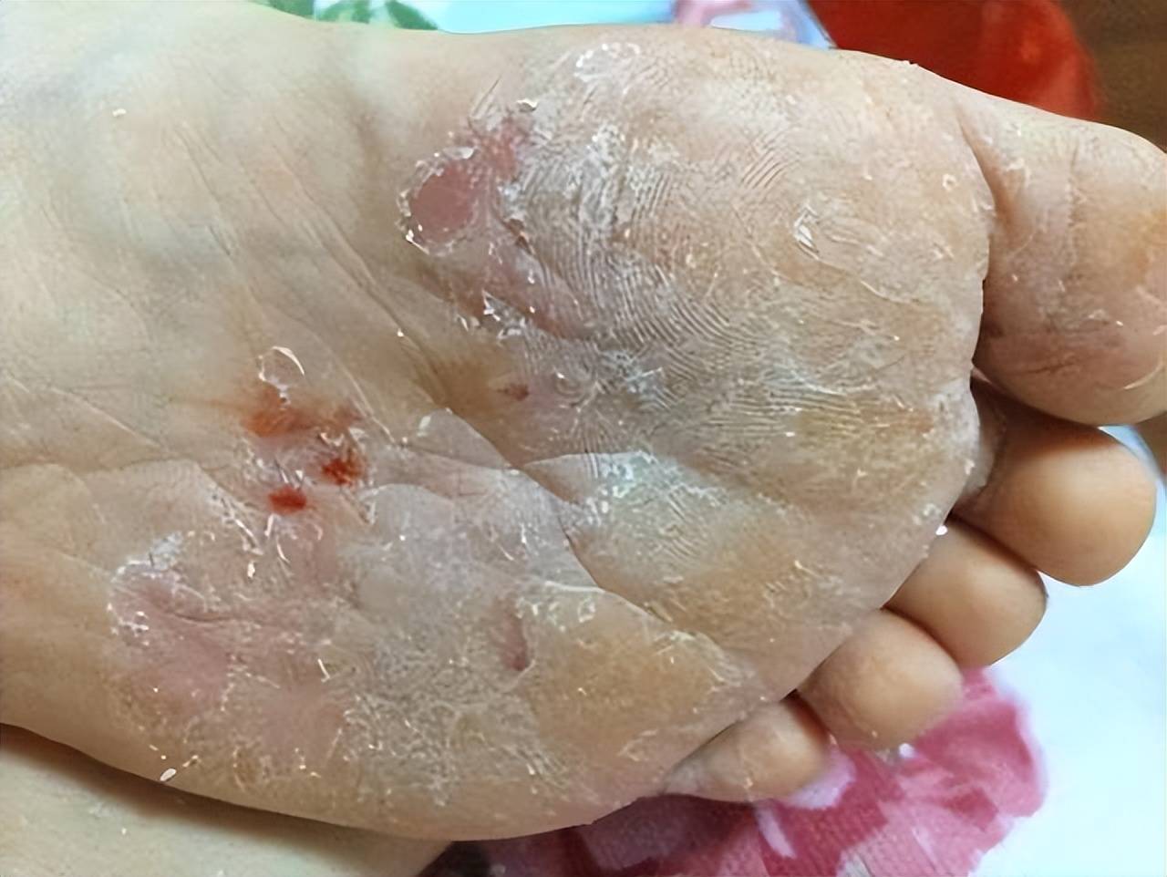 脚气反复发作总不见好!牢记这个根治方法,在家就能轻松解决!