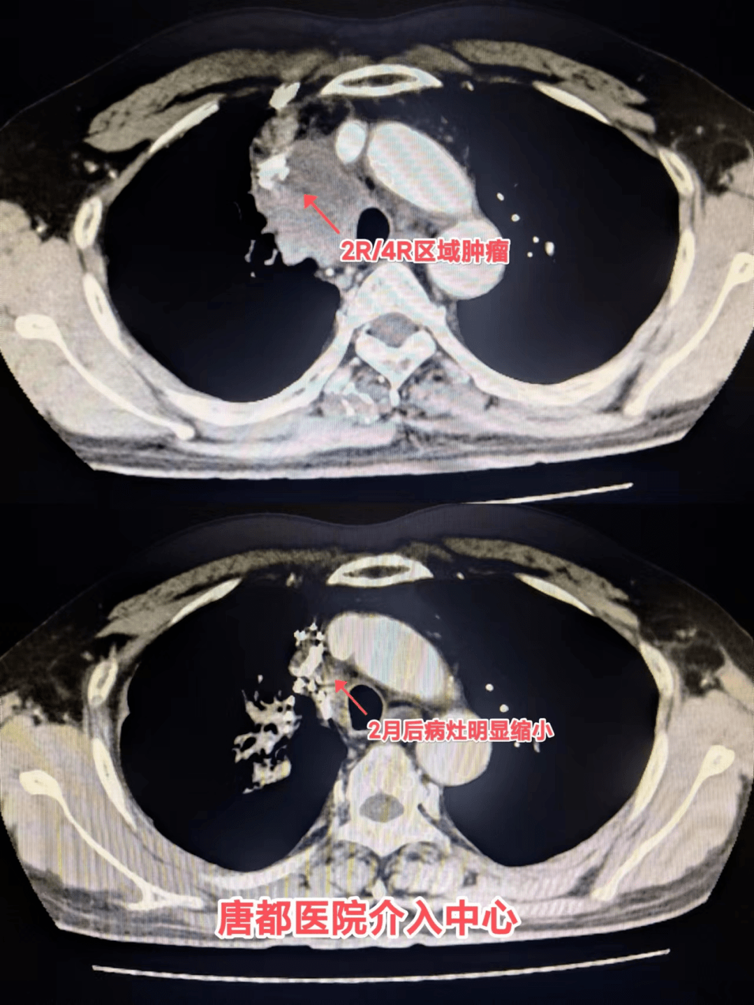 胸部增强ct 来自搜狐网
