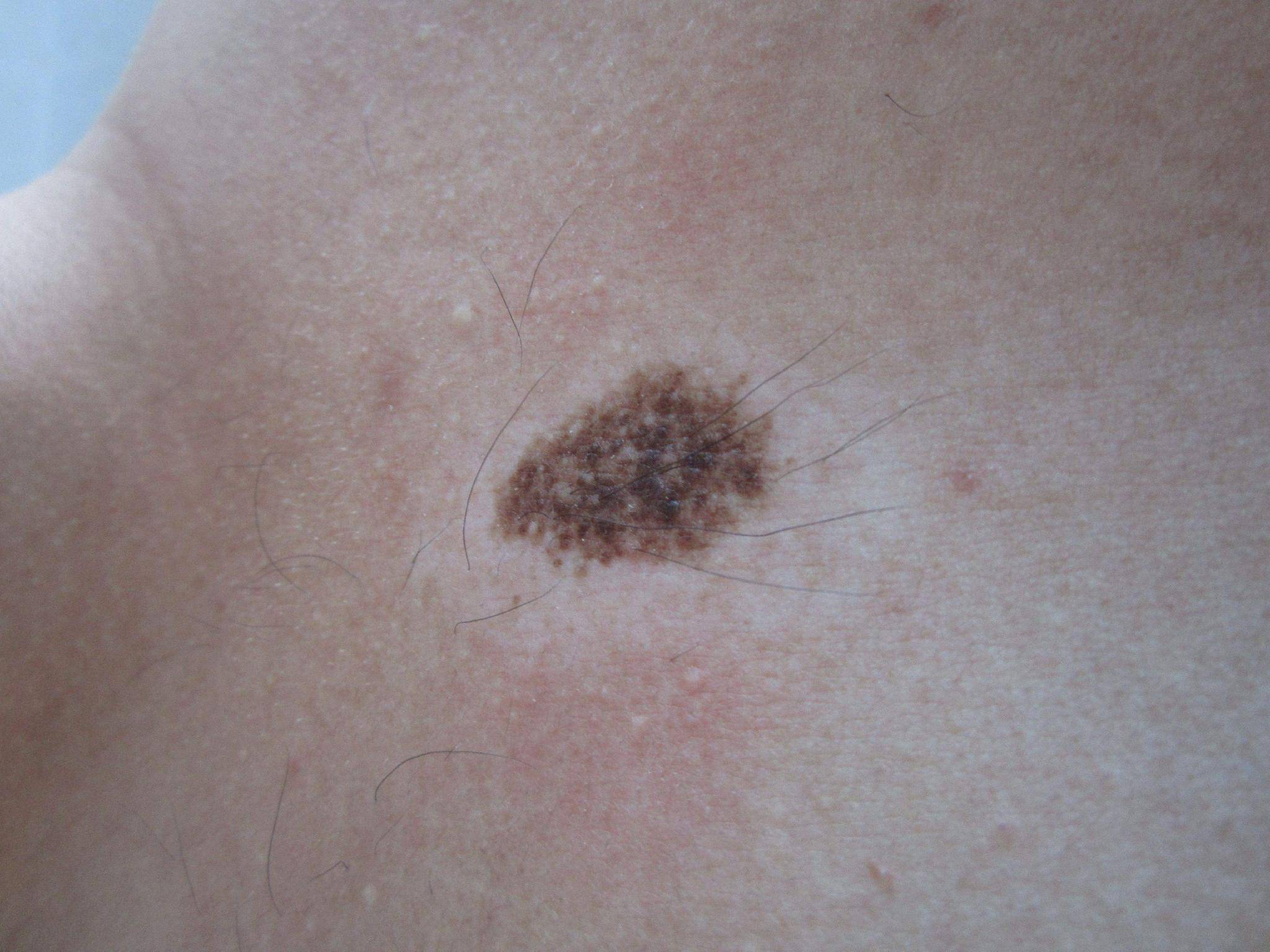 类型的hpv感染可能导致皮肤色素沉着过度,表现为皮肤上的黑点或斑块