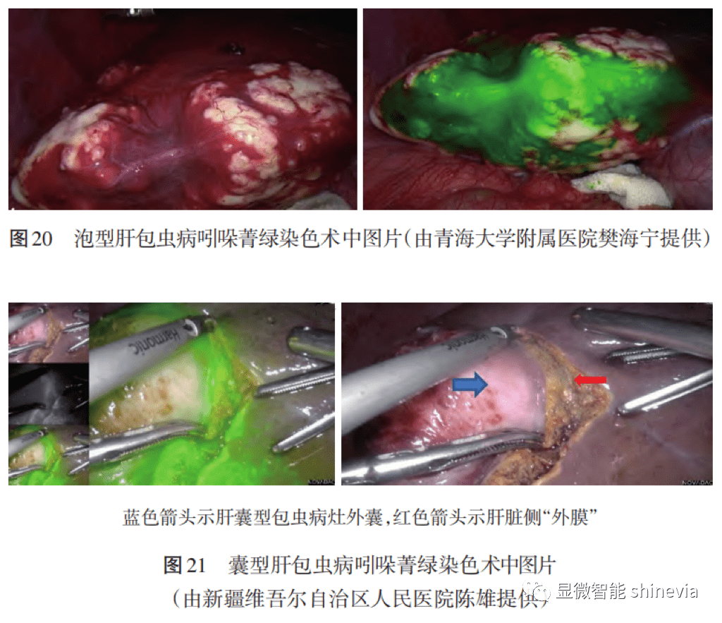 解剖性肝切除,肝内外胆管显影,活体肝移植,肝包虫病手术等方面具有