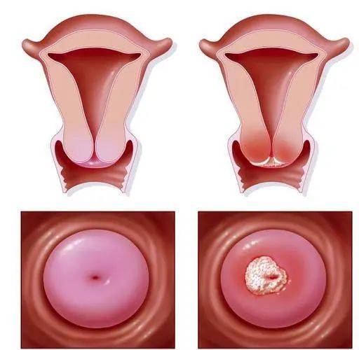 宫颈锥切后图片
