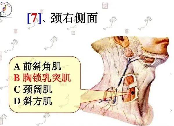 胸锁乳突肌挛缩症状图片