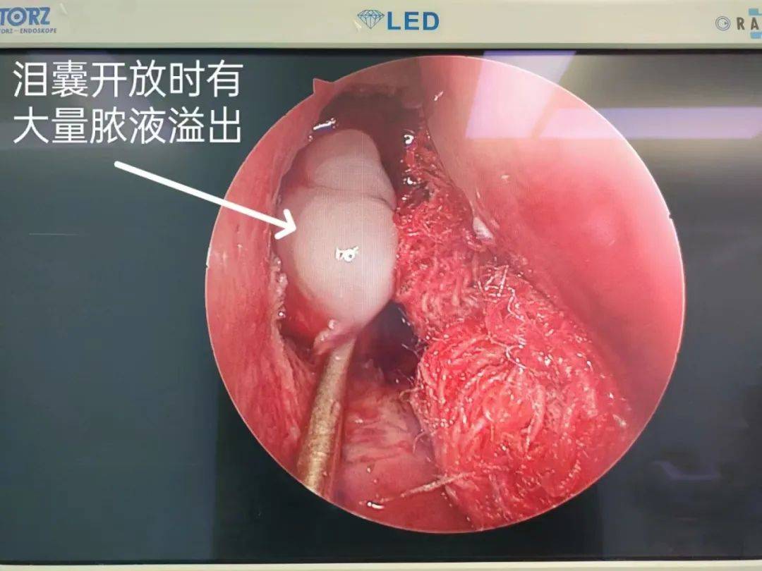 眼科疾患,竟然從鼻腔解決_手術_治療_進行