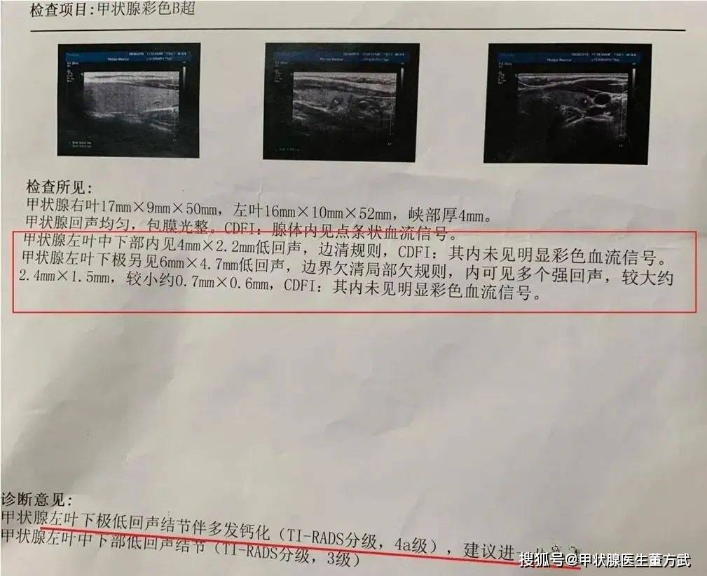 甲状腺结节遇上"钙化"就是癌?医生:别慌,分两种情况!