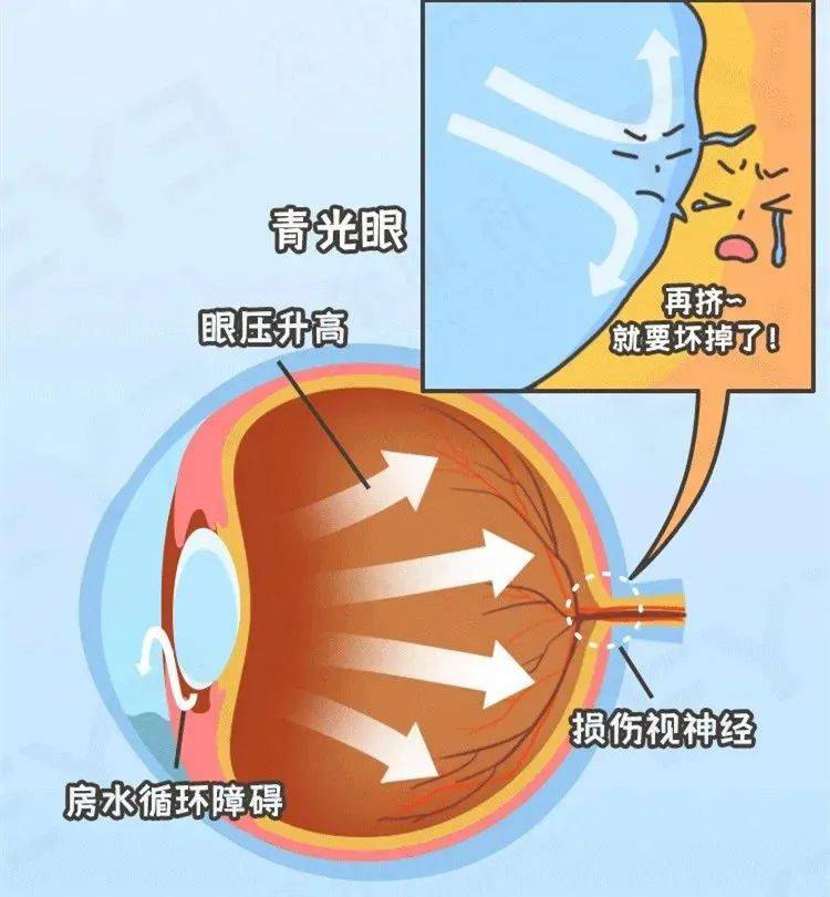 眼球外的通道有阻塞,使过多的房水滞留在眼球内,导致眼内压升高造成的