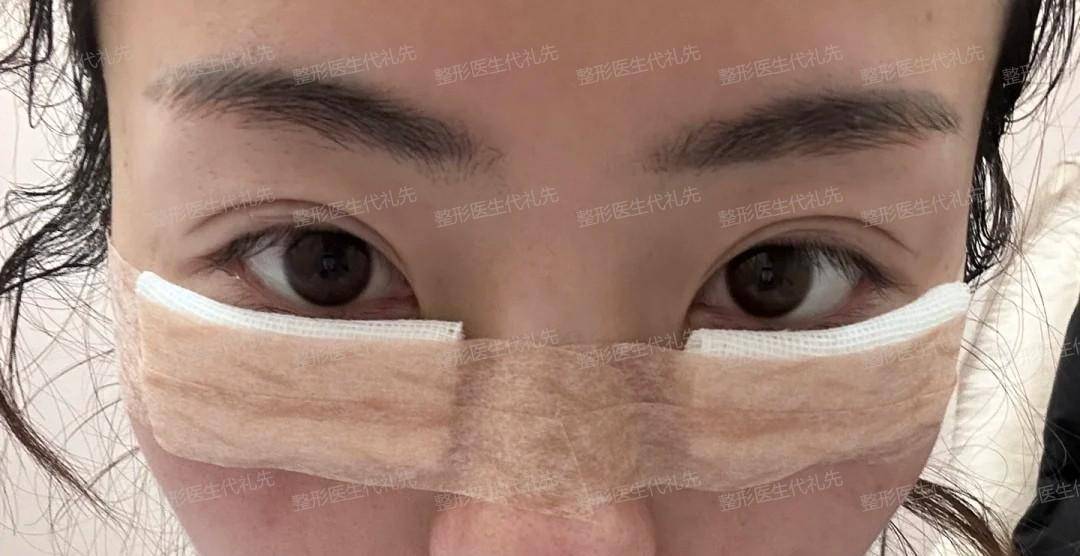 真人案例对比,内切眼袋恢复很快_手术_眼睑_皮肤