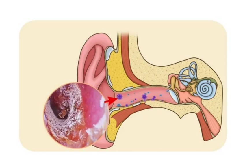 外耳道炎治疗方法图片